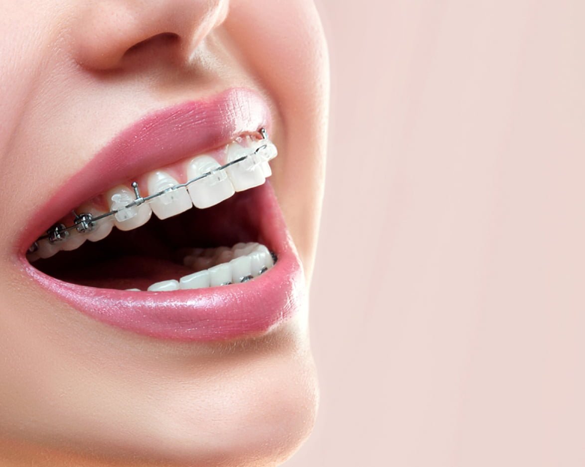 Invisalign