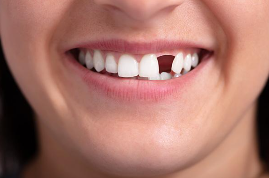 Missing Tooth is Quietly Causing Chaos in Your Mouth