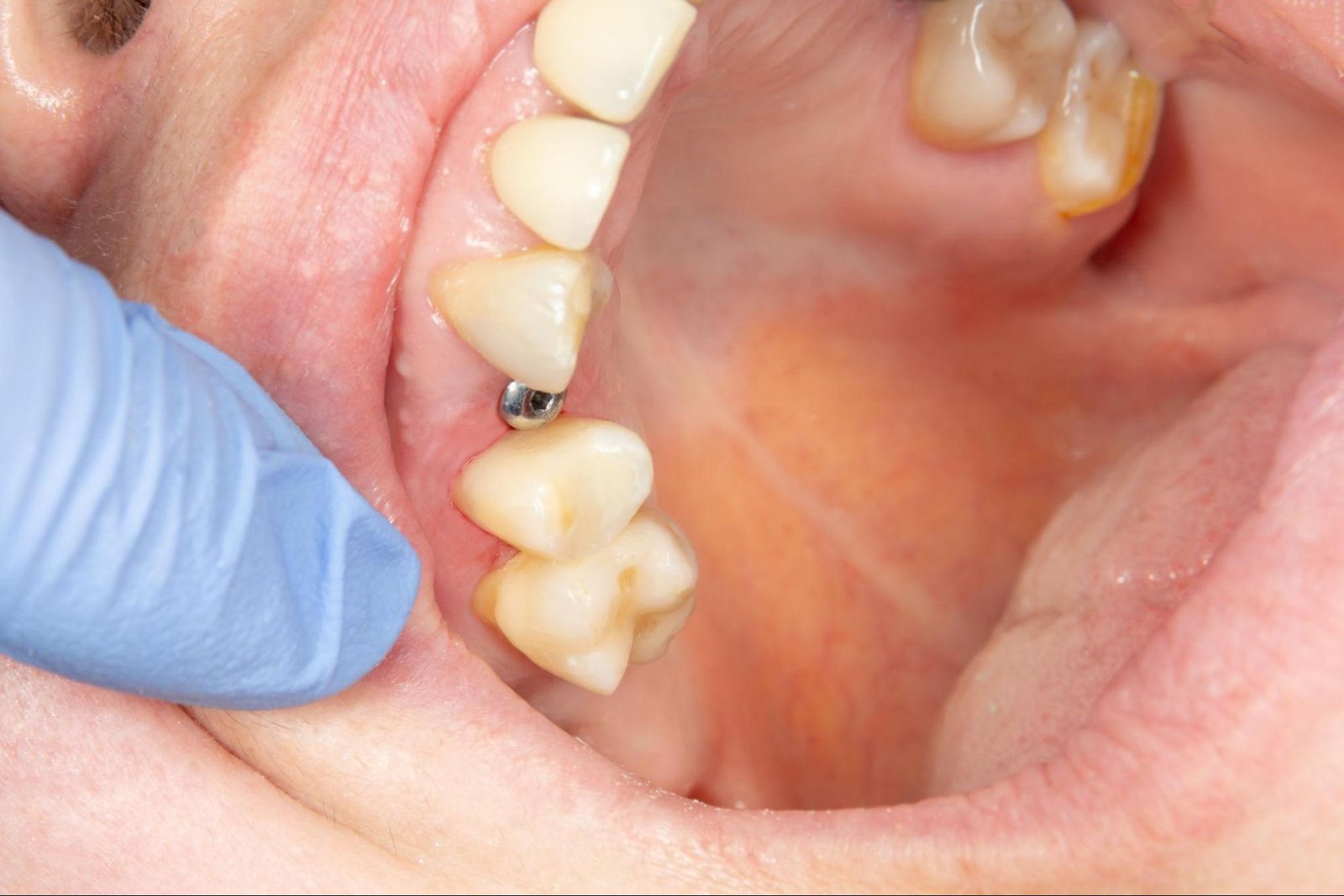 Dental Bridges

