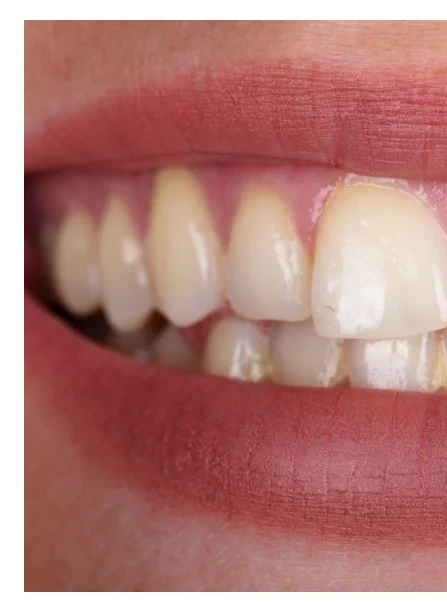 Before teeth whitening — stained teeth, Pinner Green Dental cosmetic dentist