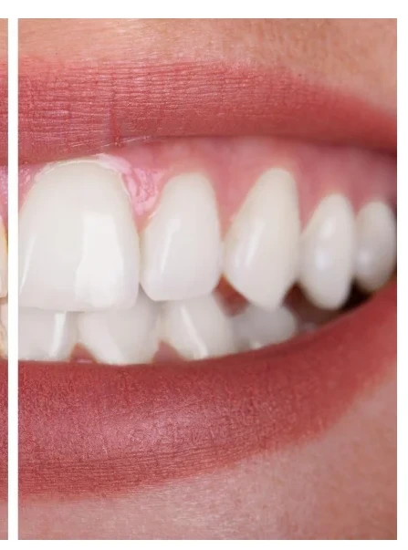 After Enlighten teeth whitening — bright smile result at Pinner Green Dental, Harrow