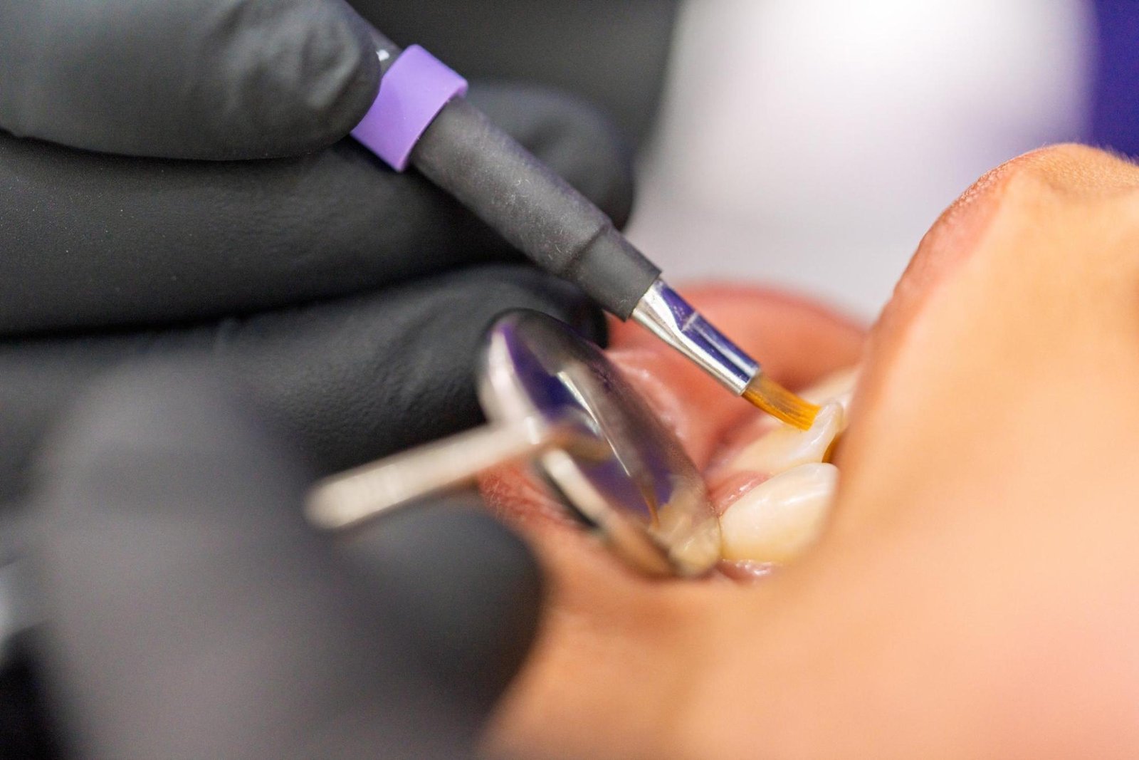 What Is Composite Bonding and Could It Improve Your Smile?