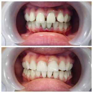 What Problems Can Composite Bonding Treat?