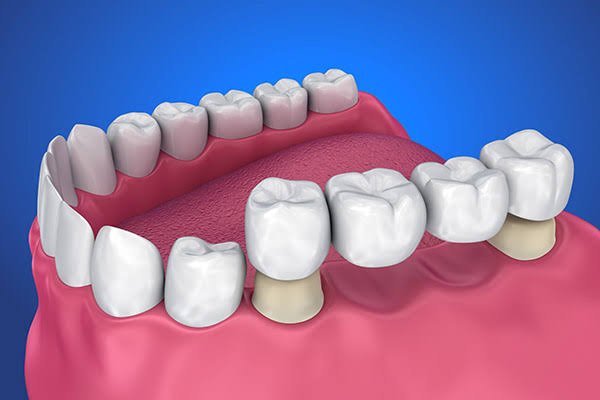 Missing a Tooth? 3 Replacement Options Explained