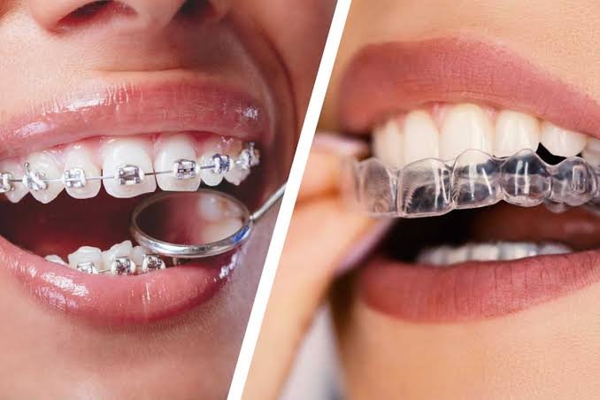 Invisalign Pinner: Does It Work, and What Does It Cost?